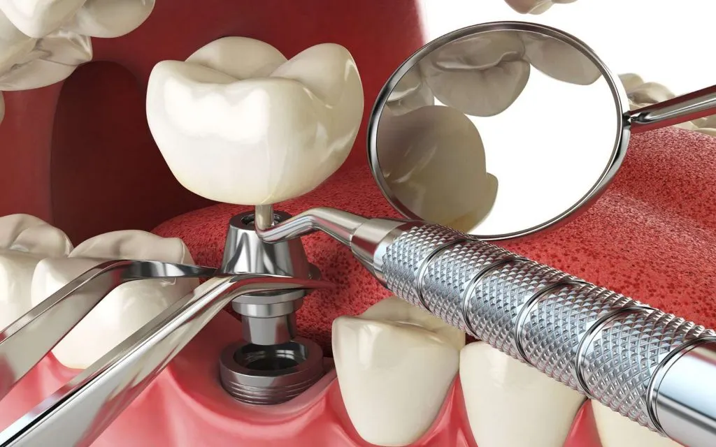 Implant dentaire : que faut-il savoir ?