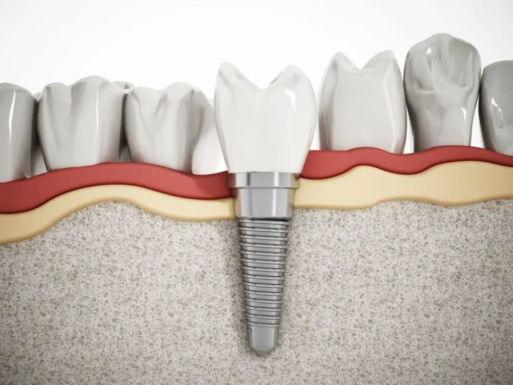 Implant dentaire : que faut-il savoir ?
